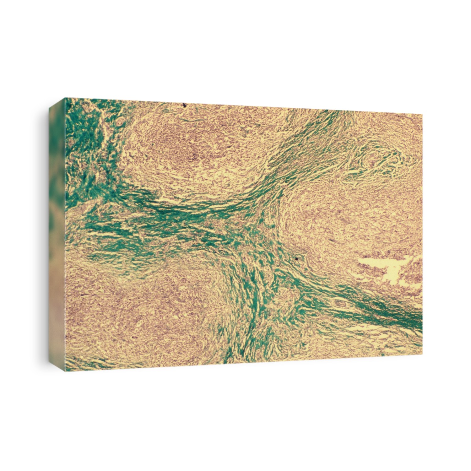 Hodgkin's disease. Light micrograph of a section through a lymph node showing nodular sclerosing Hodgkin's lymphoma. This is a malignant tumour which affects tissues in the lymphatic system, part of the body's immune system. The nodular sclerosing form causes bands of the fibrous protein collagen (green) to be laid down in lymph nodes, dividing the nodes into nodules (pink). The disease causes weight loss, lack of appetite and fevers, and the damage to the immune system means even minor infections may become life-threatening. The disease can be treated by radiotherapy and chemotherapy, and can be cured if it is treated early enough. Magnification unknown.