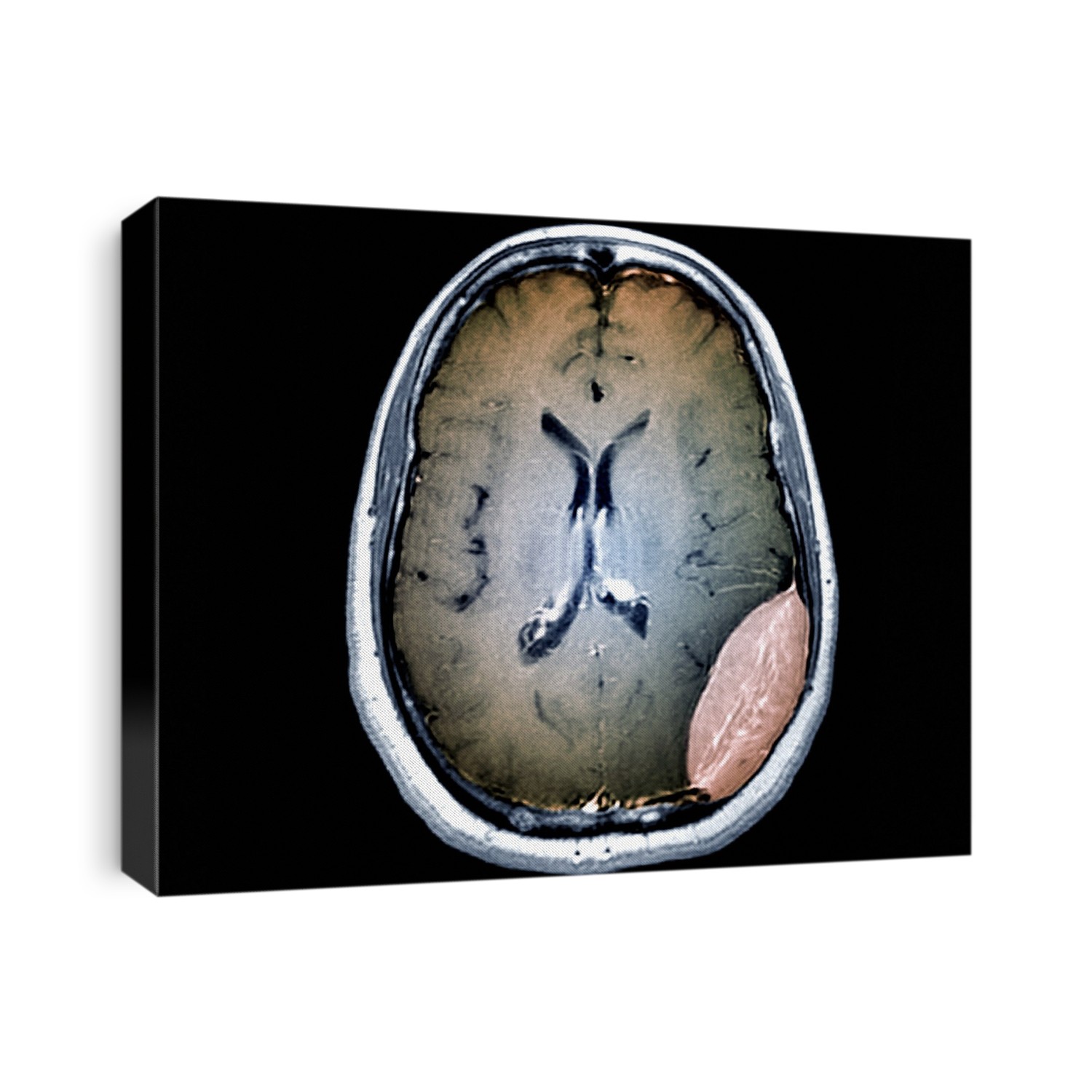 Brain cancer. Coloured magnetic resonance imaging (MRI) scan of an axial section through the brain of a 26-year-old patient with a plasmacytoma in the temporo-parietal-occipital area. Plasmacytoma is a malignant (cancerous) tumour arising from plasma cells (white blood cells) within soft tissue.